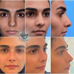 Rhinoplasty-7