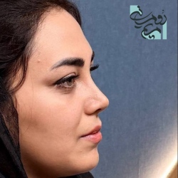 Rhinoplasty-70