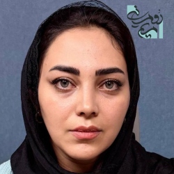 Rhinoplasty-71