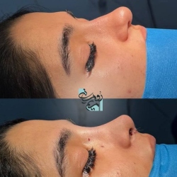 Rhinoplasty-72