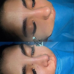 Rhinoplasty-73