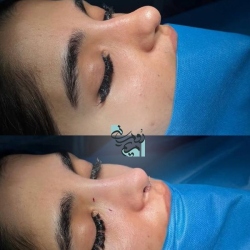 Rhinoplasty-74