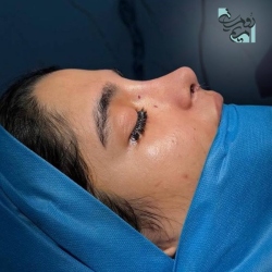 Rhinoplasty-75