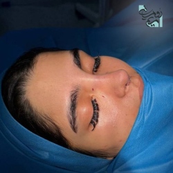 Rhinoplasty-76