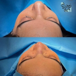 Rhinoplasty-77