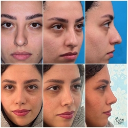 Rhinoplasty-8