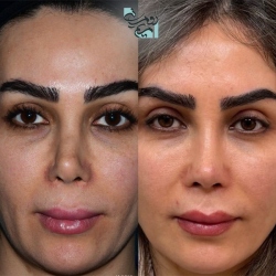 Rhinoplasty-81