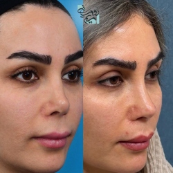 Rhinoplasty-82