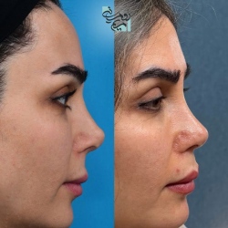 Rhinoplasty-83