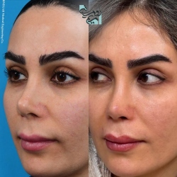 Rhinoplasty-84