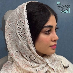 Rhinoplasty-90