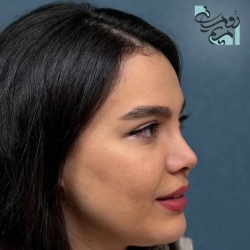 Rhinoplasty-93