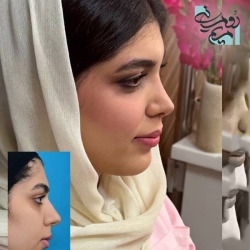 Rhinoplasty-95