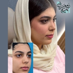 Rhinoplasty-96