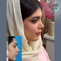 Rhinoplasty-97