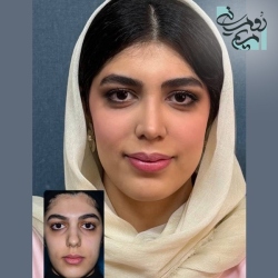 Rhinoplasty-98