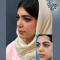 Rhinoplasty-99