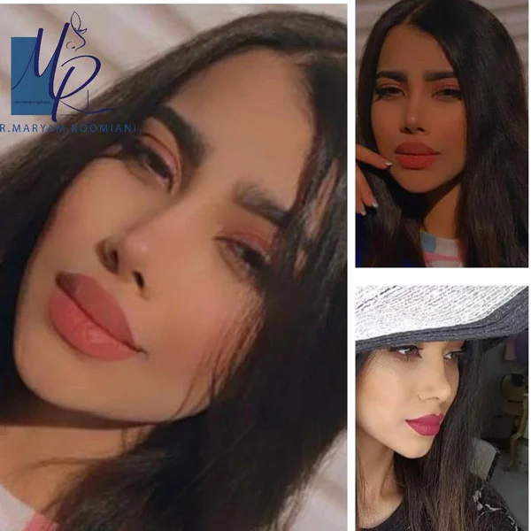 جراحی بینی استخوانی - دکتر رومیانی