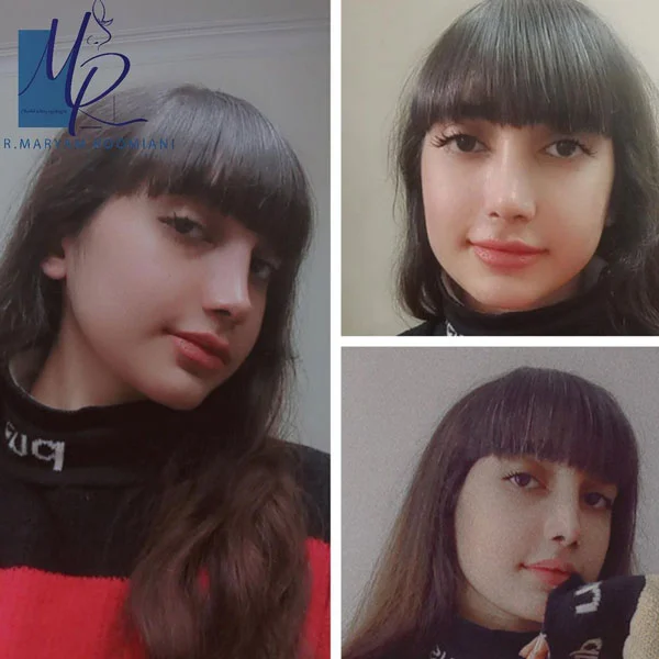 جراحی بینی - دکتر رومیانی