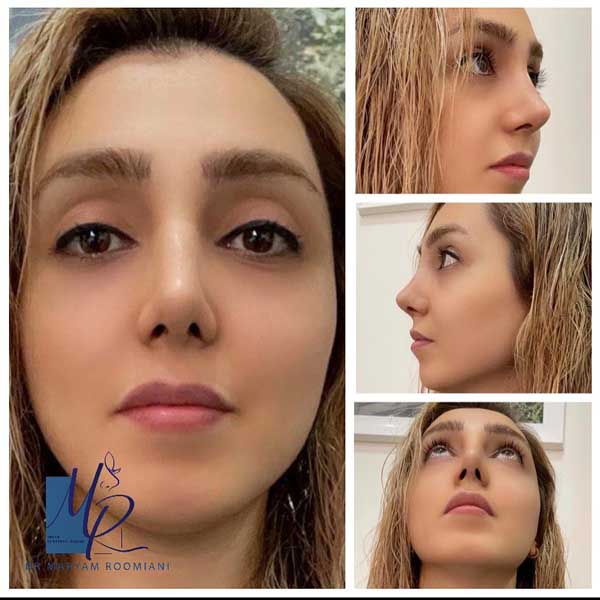 جراحی بینی استخوانی - دکتر مریم رومیانی