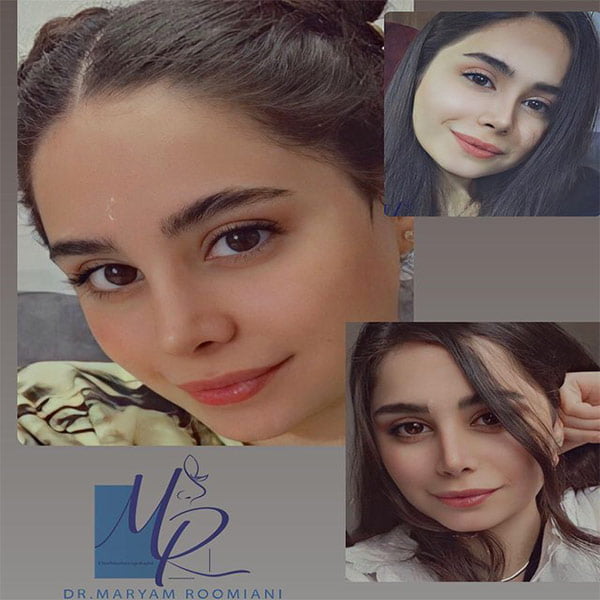 جراحی بینی نیمه فانتزی - دکتر رومیانی