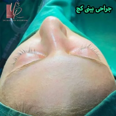 جراحی بینی کج - دکتر رومیانی