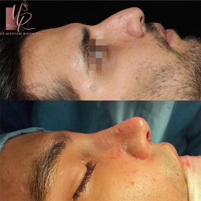 عمل بینی مردانه - دکتر رومیانی
