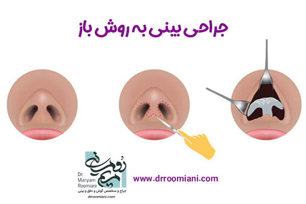 جراحی بینی باز در تهران + دکتر مریم رومیانی