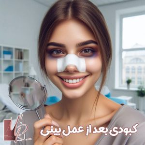 کبودی بعد از عمل بینی - دکتر مریم رومیانی