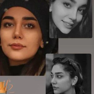 نمونه کار جراحی بینی در تهران