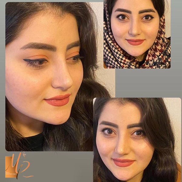 جراحی بینی طبیعی در تهران - دکتر مریم رومیانی