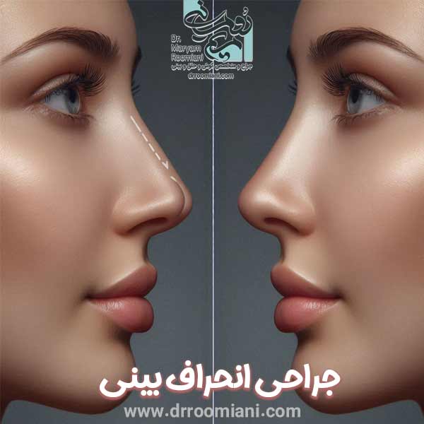 جراحی انحراف بینی - دکتر مریم رومیانی در تهران