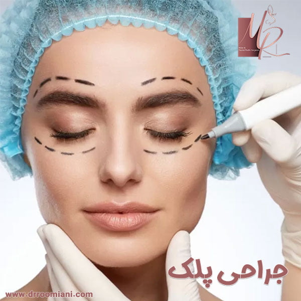 جراحی پلک - دکتر مریم رومیانی