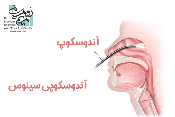 جراحی آندوسکوپی سینوس - دکتر مریم رومیانی
