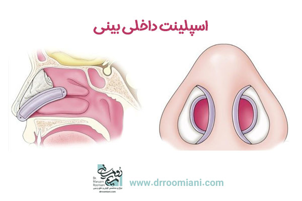 اسپلینت بینی - دکتر مریم رومیانی