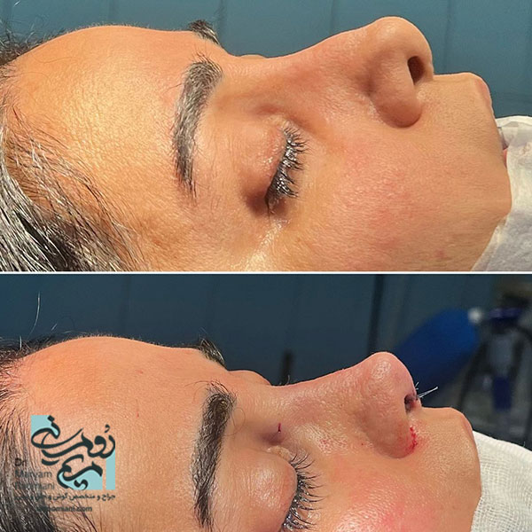 جراحی ترمیمی بینی + دکتر مریم رومیانی