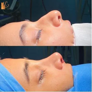 جراحی بینی در تهران - دکتر مریم رومیانی