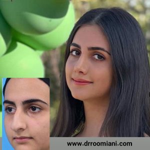 جراحی بینی استخوانی - دکتر مریم رومیانی