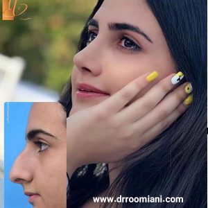 جراحی بینی استخوانی - دکتر مریم رومیانی