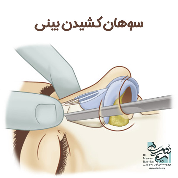 سوهان کشیدن بینی + دکتر مریم رومیانی