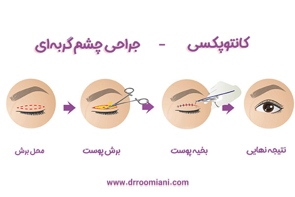 جراحی پلک - دکتر مریم رومیانی