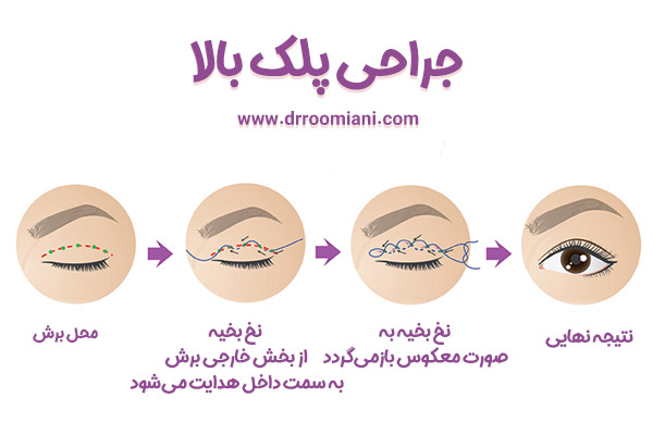 جراحی پلک - دکتر مریم رومیانی