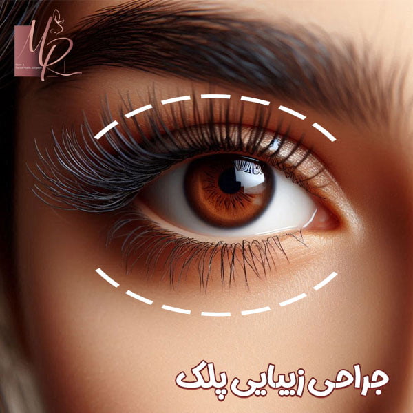 جراحی پلک با دکتر مریم رومیانی
