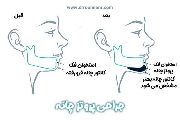 جراحی پروتز چانه در تهران + دکتر مریم رومیانی