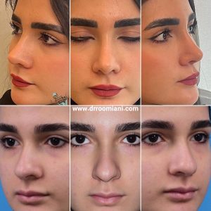 جراحی بینی در تهران - دکتر مریم رومیانی