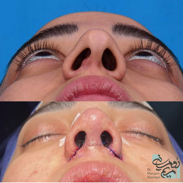عدم تقارن سوراخ‌ های بینی + دکتر مریم رومیانی