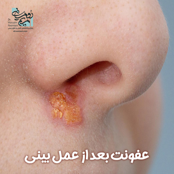 عفونت بعد از عمل بینی + دکتر مریم رومیانی