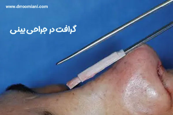 گرافت در جراحی بینی + دکتر مریم رومیانی