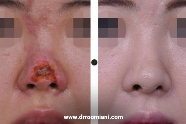 نکروز بعد از عمل بینی + دکتر مریم رومیانی