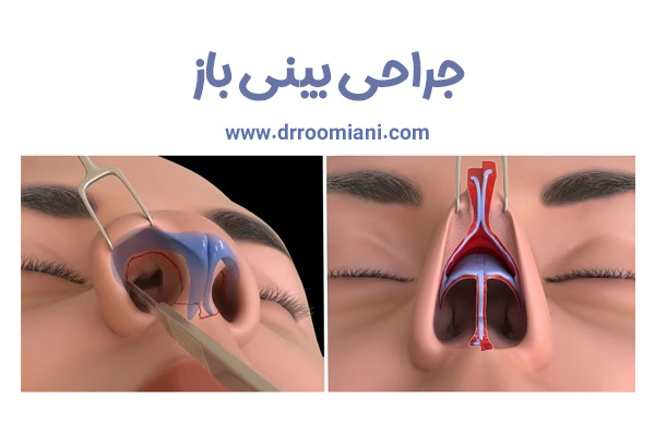 جراحی بینی باز در تهران + دکتر مریم رومیانی